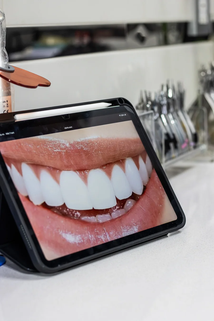 Resultado de un blanqueamiento dental visto en la pantalla del consultorio