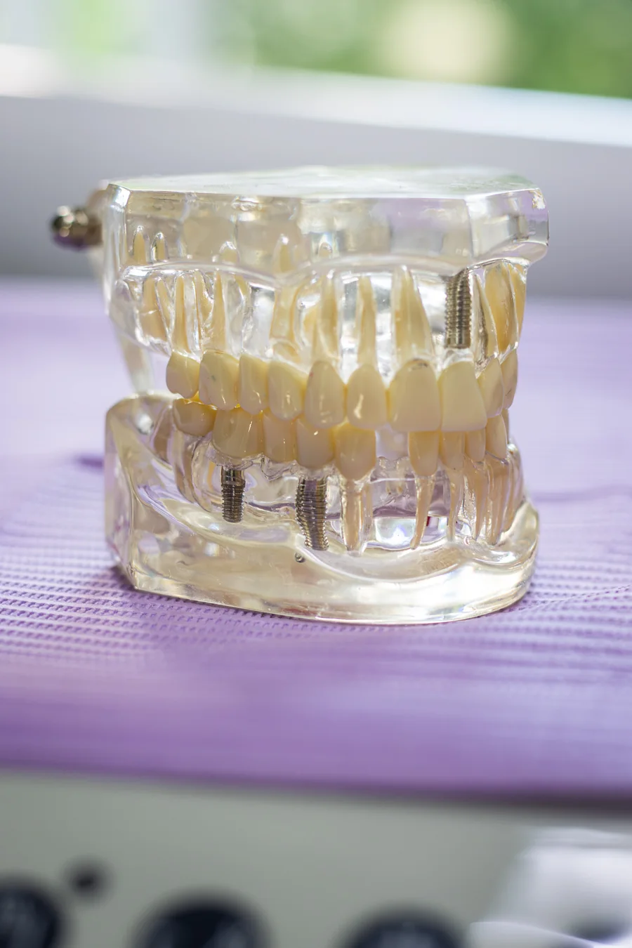 Modelo anatómico que muestra un implante dental y su corona